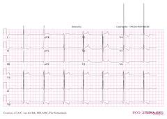 lv overbelasting|Hypertrofie en dilatatie .